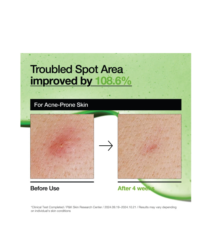 Anua Azelaic Acid 10 Hyaluron Redness Soothing Serum Korean Skincare 30ml / 1.01 fl. oz.